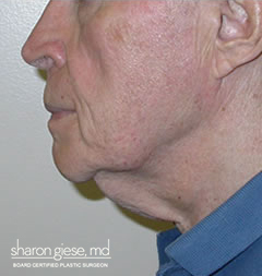 neck lift before picture